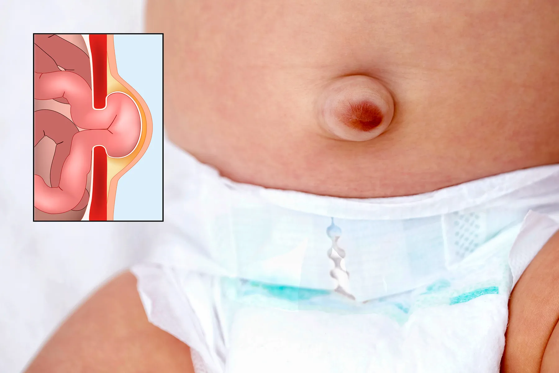 Understanding Hernia in Children: When Surgery Is Needed