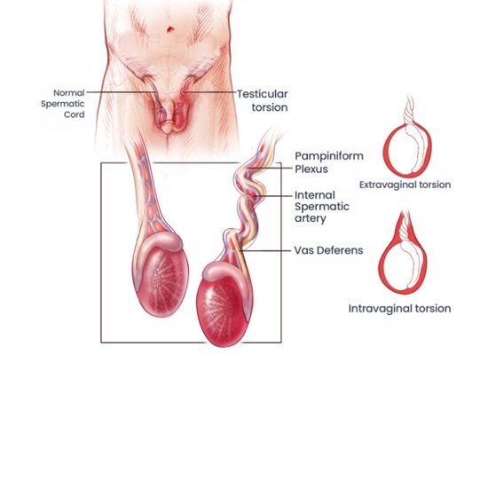 Testis Surgery in Ahmedabad